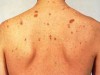 Manchas avermelhadas na pele, sintoma do portador do Sarcoma (Foto: Divulgação)