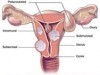 Os miomas podem nascer dentro ou fora do útero,segundo especialistas (Foto: Reprodução)