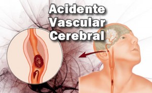 Imagem da notícia - AVC pode ser prevenido com hábitos saudáveis, lembram especialistas