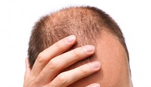 Imagem da notícia - Cientistas criam cabelo em laboratório e se aproximam da cura da calvície