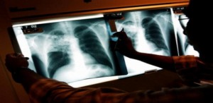 Imagem da notícia - Teste rápido de tuberculose começa este mês em Manaus e em outras cinco cidades do País