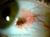 NEVUS-CONJUNTIVA