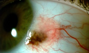 Pintas ou sinais na superfície dos olhos, geralmente desde criança, que podem aumentar ou ficar mais escuras, o oftalmologista pode determinar se é apenas uma pinta benigna ou se é necessário remover a pinta com cirurgia. (Foto: Divulgação/Unifesp)