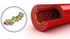 Cholesterol plaque in artery and cholesterol model
