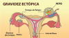 gravidez_ectopica_pequeno