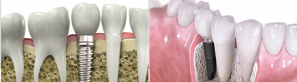 PRÓTESE DENTÁRIA - FOTO DIVULGAÇÃO 02