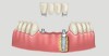 PRÓTESE DENTÁRIA - FOTO DIVULGAÇÃO