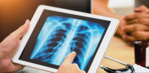 Imagem da notícia - Estudo genético caracteriza os mecanismos inflamatórios que atuam no desenvolvimento da Tuberculose