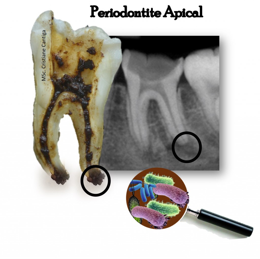 Periodontite apical(1)